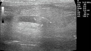 Figure 6. Ultrasound of stone in ureter.