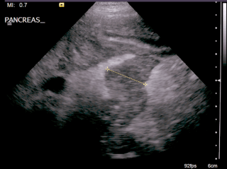 Figure 2. Ultrasonographic appearance of acute pancreatitis in a four-year-old male neutered bichon frise, with enlarged hypoechoic pancreas and surrounding hyperechoic mesenteric fat.