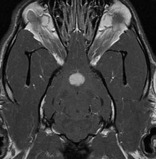 Figure 2. Dorsal 3D fast imaging employing steady-state acquisition post-contrast MRI of the brain of a dog affected by a pituitary tumour.