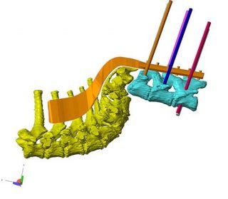 Figure 7a. Computer-aided design 3D image of the thoracolumbar spine with the custom designed plate (orange) and cylinders representing the planned screw trajectories.