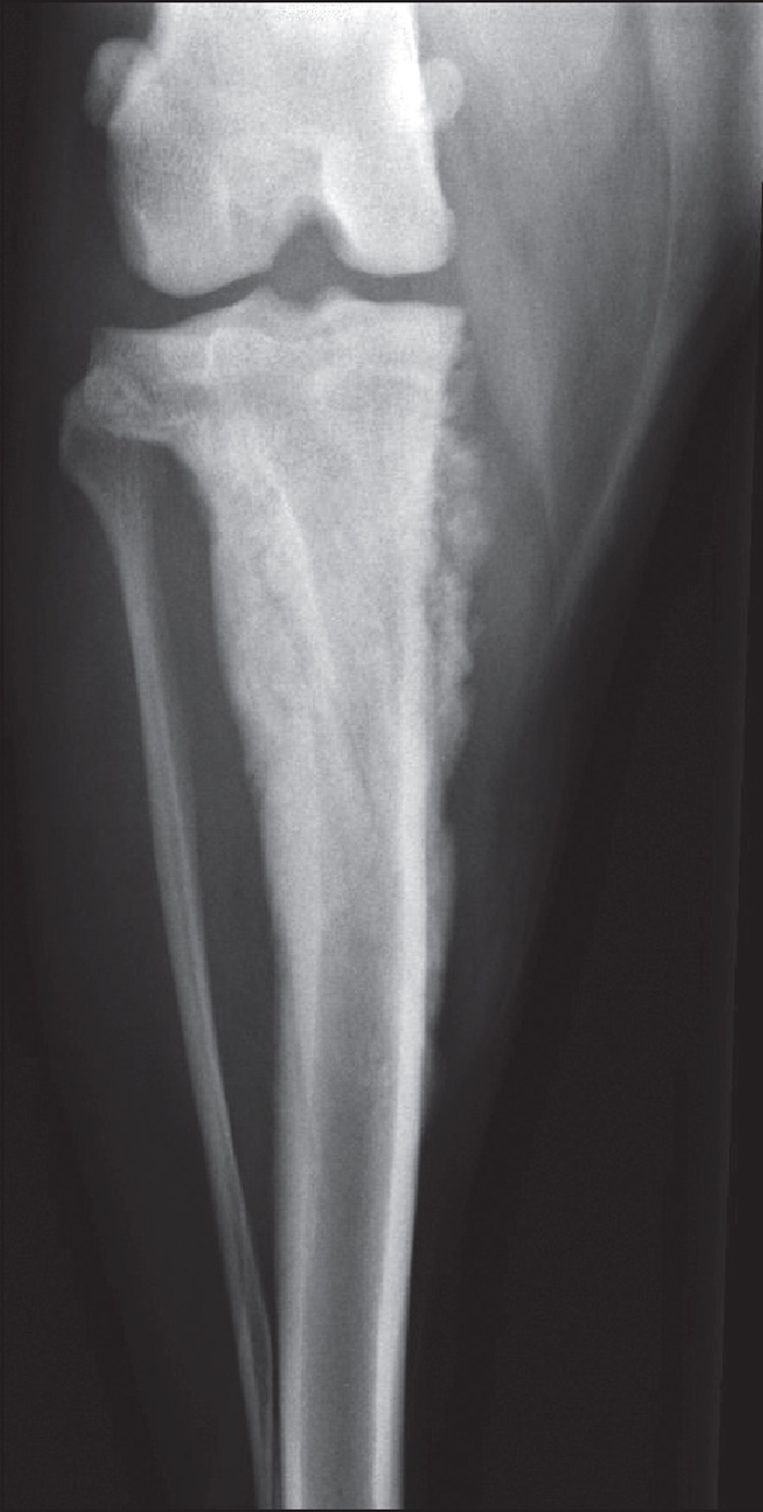 Malignant or benign? Diagnosis from radiographic features of bone