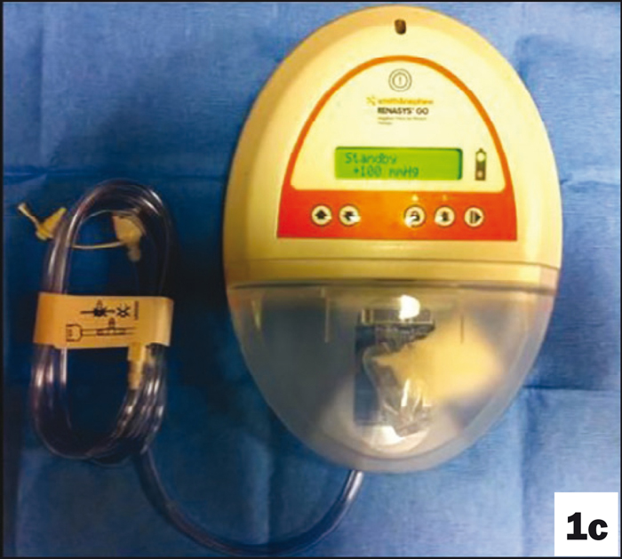 Suck it and see part two method of application and pitfalls of NPWT