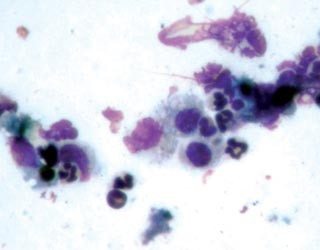 Figure 5. Neutrophils are the most commonly seen inflammatory cells in otitis cases.