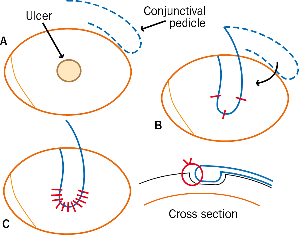 A conjunctival pedicle graft surgical procedure.