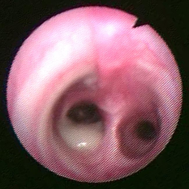 Figure 10. View of the carina in a dog with chronic bronchitis. There is a large plug of mucus in the right mainstem bronchus.