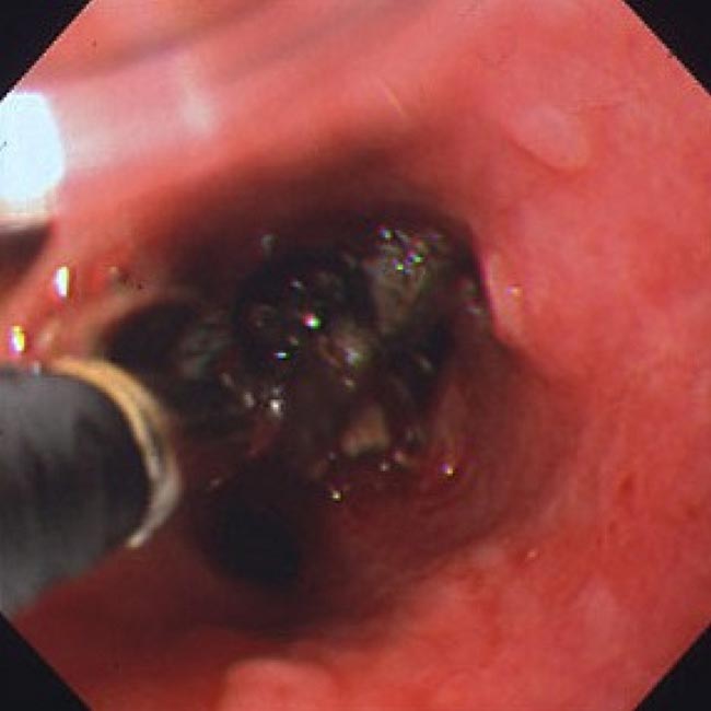 Figure 11. A bronchial foreign body (head of corn) lodged in a right caudal bronchi.