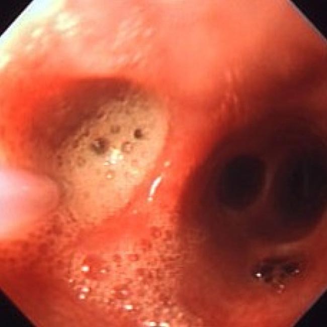 Figure 18. Frothy liquid appearing from a terminal bronchus during BAL collection using a wash tube.