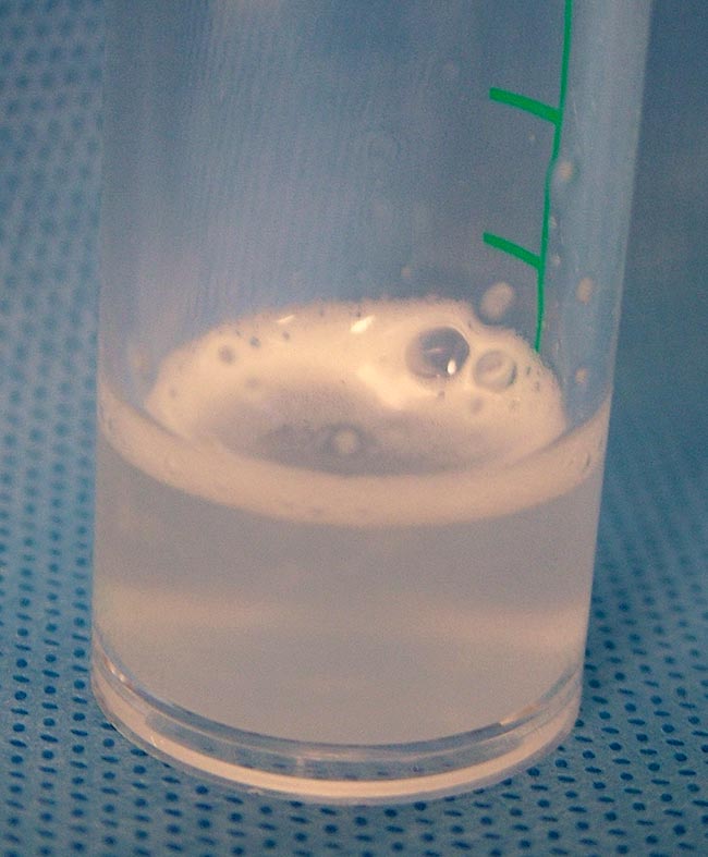 Figure 19. Frothy BAL fluid, confirming fluid has been obtained from the alveoli as it contains surfactant.