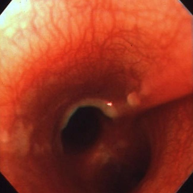 Figure 5. Hyperaemic trachea with prominent submucosal vessels and mucus accumulation in a dog with infectious tracheobronchitis.