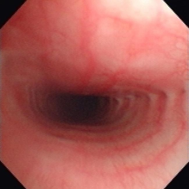 Figure 7. Mild tracheal collapse in a Yorkshire terrier.