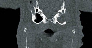 Figure 15. CT examination should show a soft tissue density within the surgial site.