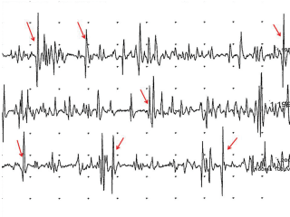 Figure 5. Electromyography (temporalis muscle) from an eight-year-old Labrador retriever with MMM. Note the multiple fibrillation potentials (some of them have been highlighted with red arrows).