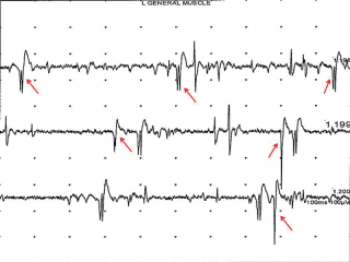 Figure 6. Electromyography (masseteric muscle) from the same dog as in Figure 5. Note the multiple positive sharp waves (some of them have been highlighted with red arrows).