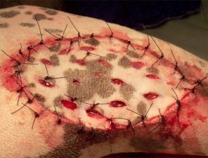 Meshed skin graft