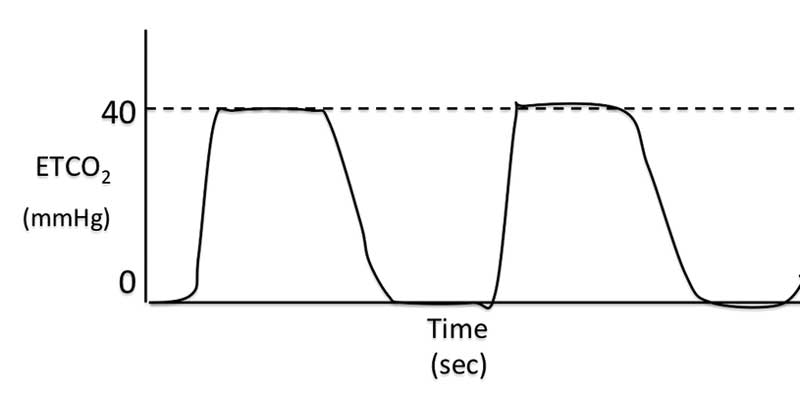 Figure 10. Increased beta angle, indicating slow inspiration, CO2 in inspired gas or malfunctioning inspiratory valve on rebreathing system.