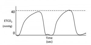 Figure 5. Slow expiration time on capnogram.