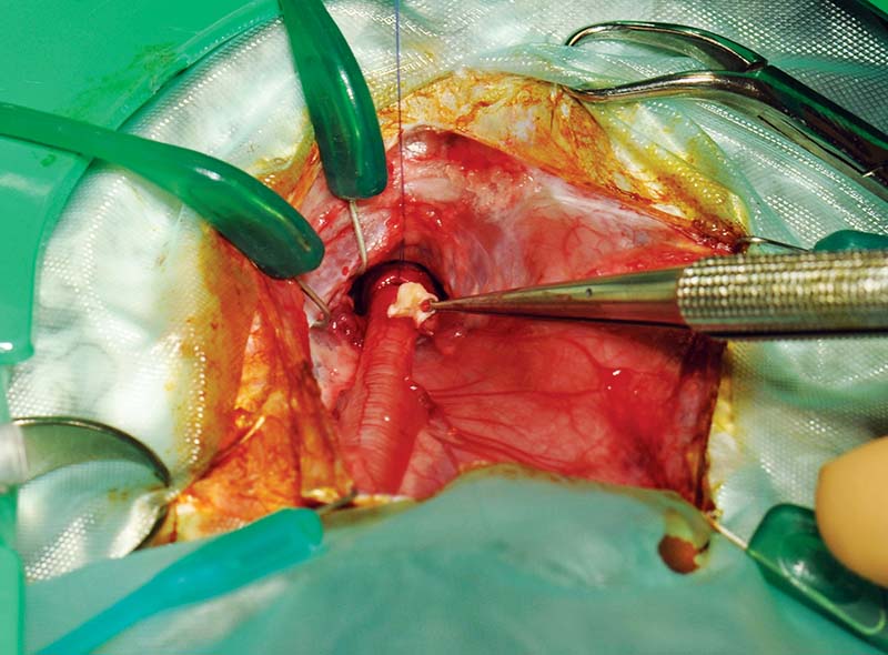 Figure 13. Tracheotomy in process, with removal of aspergilloma.