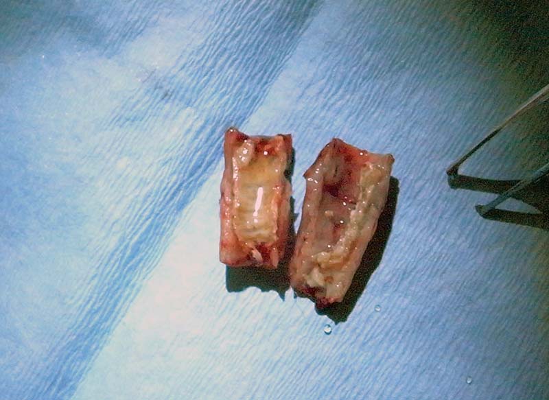 Figure 14. Section of diseased trachea following resection. The patient made a full recovery in three days, having been under treatment with various vets for several months.