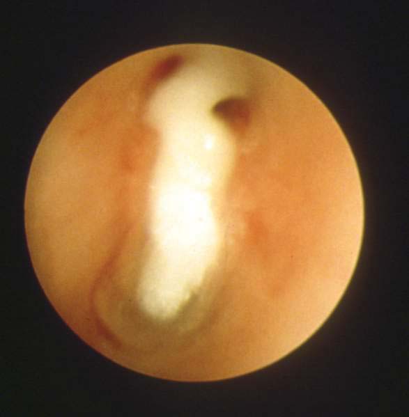 Figure 9. Advanced Aspergillosis lesion.