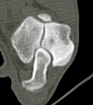 Figure 2. CT scan of a typical incomplete ossification of the humeral condyle lesion, which is a complete intracondylar fissure. Bone is sclerotic either side of the fracture line.