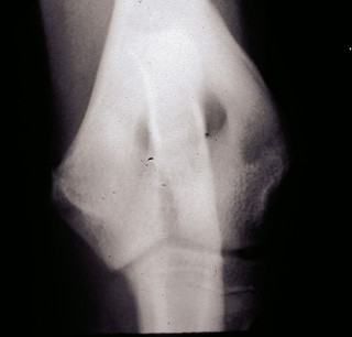 Figure 3. Craniocaudal radiograph of a springer spaniel demonstrating incomplete ossification of the humeral condyle. In addition to the radiolucent zone in the middle of the humeral condyle, note also the smooth periosteal reaction on the lateral epicondylar ridge – a response to the increased stress in this region caused by the discontinuity of the condyle.