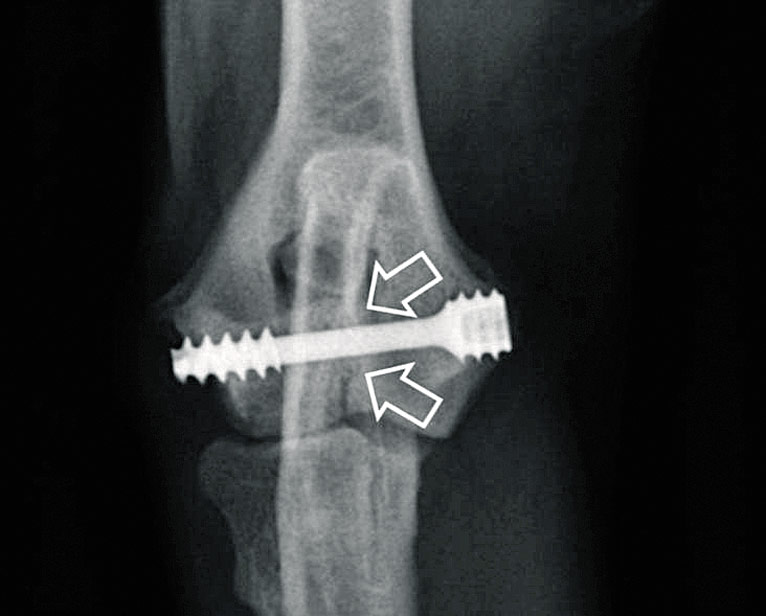 Figure 4b. An eight-week follow-up radiograph of a springer spaniel treated with the IOHC screw demonstrating union across the humeral intracondylar fissure. Image: Mark Straw.