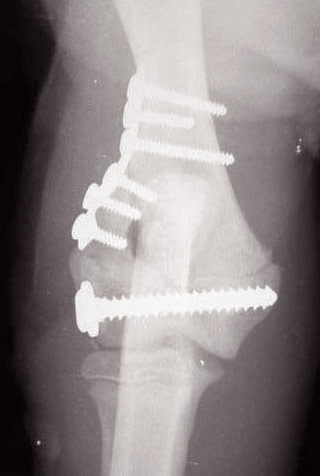 Figure 5. Repair of a lateral condylar fracture in an immature springer spaniel. A transcondylar lag screw has been placed distal to the distal humeral growth plate and combined with a lateral epicondylar plate and screws to resist rotation and to protect the transcondylar implant. Image: Malcolm McKee.