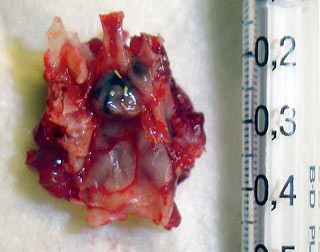 Figure 6 (right). Gross appearance of a large pituitary tumour in a female rat. Notice the reddish brown  colouration with a  haemorrhagic appearance.