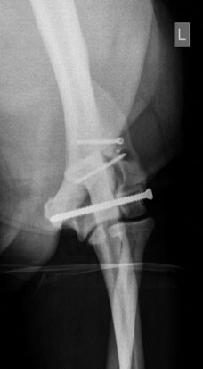 Radiograph of Claudia’s elbow following placement of three screws.