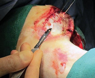 Figure 2. Sharp debridement is one of the clinician’s most useful tools. Use it conservatively, but as often as necessary. 