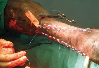 Figure 3. Quills made for sterile intravenous drip tubing and used with a mattress suture pattern can assist in dissipating tension and protecting the skin edges.