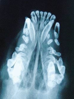 Rubber jaw, the decreased mineralisation of bone due to secondary hyperparathyroidism.