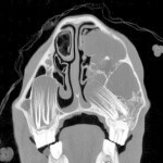 Figure 10a. CT image at the level of the 208 tooth of a two-year-old Thoroughbred colt with facial swelling and nasal discharge. There is displacement of the adult 208 tooth and a cystic-like structure within the rostral maxillary sinus. A frontal sinus flap allowed debridement of a large sinus cyst within the left paranasal sinus, which had presumably caused the abnormal eruption of the permanent teeth.