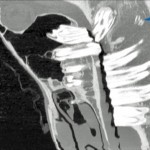 Figure 12a. Longitudinal image from a seven-year-old horse with a persistent discharging sinus tract on the ventral aspect of the left mandible. The horse had the 310 tooth extracted 12 months previously and enamel fragments had been identified on plain radiographs and presumed to be the cause of the discharging tract.