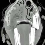 Figure 13. CT image of a large patent oronasal fistula in a nine-year-old pony. The fistula was located at the site of a previous 108 extraction and food material is clearly visible within the nasal meati. There is gross sclerosis of the maxillary bone due to the presence of chronic infection. The fistula was repaired with a nasolabialis muscular pedicle graft.