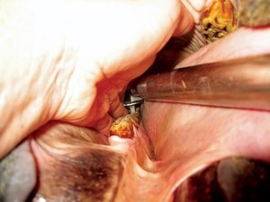 Diastema widening is a category 3 procedure.