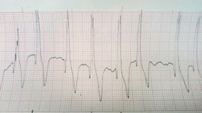 ECG from a dog with AF