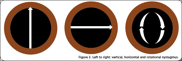 Figure 3. Left to right: vertical, horizontal and rotational nystagmus.