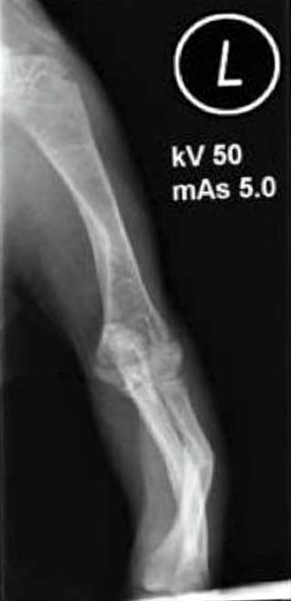 Figure 3. Poor bone mineralisation, thin cortices and spontaneous fractures in a cat with nutritional hyperparathyroidism.