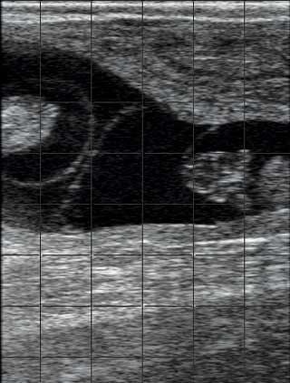 A twin diagnosis made by ultrasound.