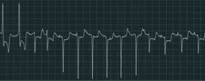 Figure 5a. An examples of an ECG recording from atypical myopathy cases: multiform ventricular tachycardia.
