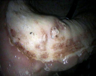 Figure 1. Squamous mucosal ulcers at lesser curvature, which tend to heal predictably following omeprazole treatment.