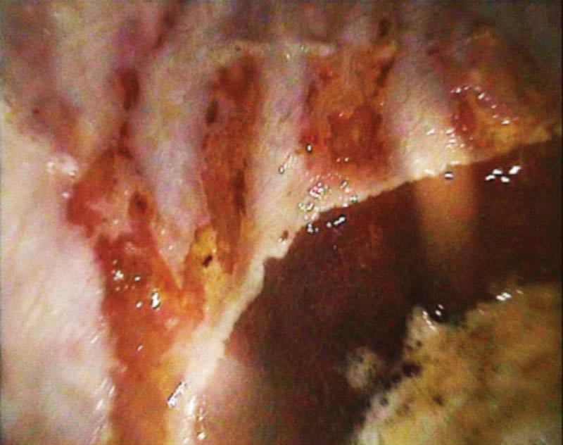 Figure 3. Squamous mucosal ulcers on the greater curvature, probably related to acid-splash injury.