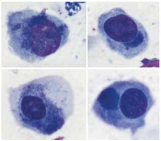 Figure 2. Cytological features of infection. Purple-staining inclusions are present in epithelial cells often clustered around the nucleus (×100 magnification, Romanowsky stain). Accompanying inflammatory cells (neutrophils, lymphocytes, macrophages) should always be seen. Reproduced from Hillström et al4.