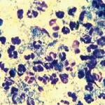 Figure 5. Pseudomonas infection on cytology from an ear. Image: Susan Paterson.