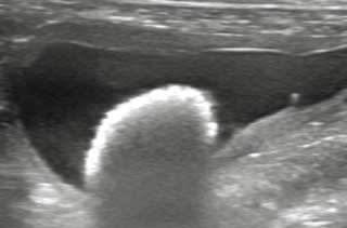 Figure 1. An ultrasound image of a large urolith in the bladder. Image: Andrew Parry/Willows Veterinary Centre and Referral Centre.