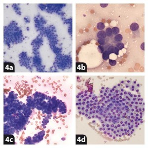 Figure 4. Examples of epithelial cell arrangements. 4a. Trabecular (transitional cell carcinoma). 4b. Acinoid (anal sac adenocarcinoma). 4c. Palisading (trichoblastoma). 4d. Honeycomb (benign prostatic hyperplasia).