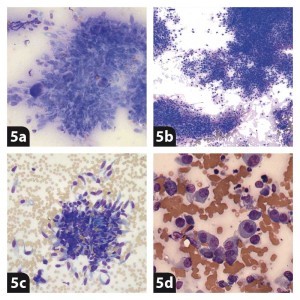 Figure 5. Examples of mesenchymal cell arrangement and morphology. 5a. Storiform. 5b. Perivascular (courtesy of Francesco Cian). 5c. Spindle-shaped cells (well differentiated spindle cell tumour). 5d. Plump, oval spindle cells (poorly differentiated spindle cell tumour).