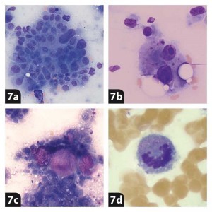 Figure 7. Criteria of malignancy. 7a. Anisokaryosis, karyomegaly, nuclear moulding, anisocytosis. 7b. Binucleation, nuclear fragmentation, prominent large nucleoli. 7c. Atypical cytoplasmic inclusions. 7d. Mitosis.