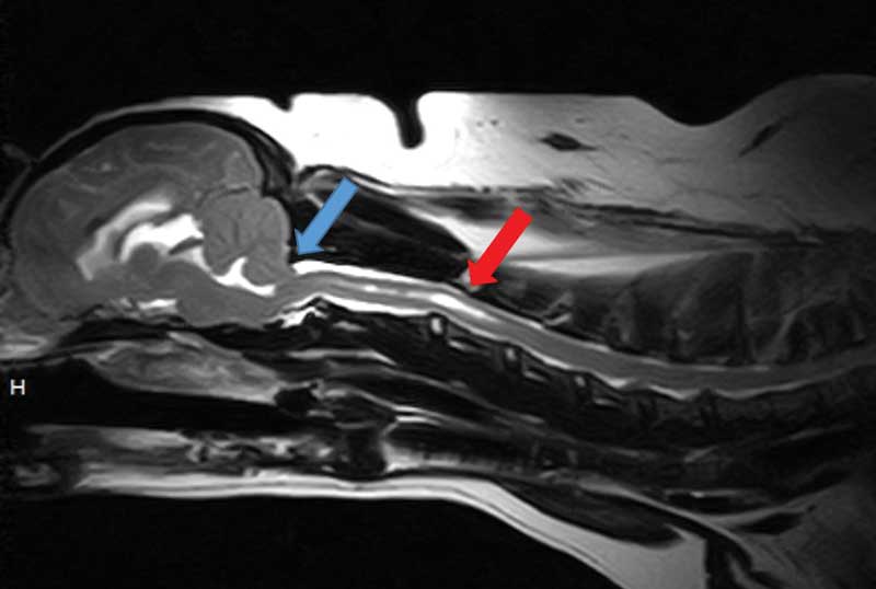 Figure 3. An MRI study of the head and neck of a three-year-old cavalier King Charles spaniel presented with intermittent episodes of neck pain. This sagittal T2-weighted image revealed mild Chiari-like malformation (blue arrow) and syringomyelia affecting the cranial cervical spinal cord (red arrow).